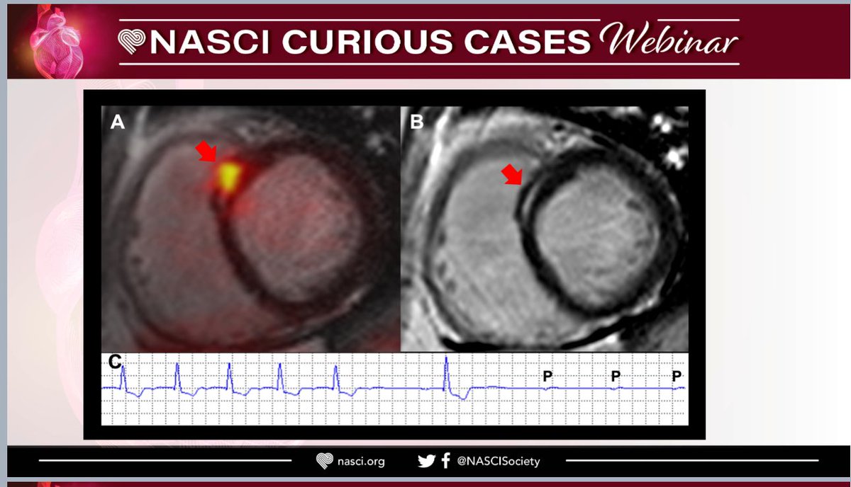 Busra Cangut, MD, MS (@busracangutmd) on Twitter photo Grateful to <a href="/NASCISociety/">NASCI</a> for the opportunity to present interesting cardiovascular cases I encountered during my training, using multiple imaging modalities, at the monthly webinar. <a href="/MountSinaiHeart/">Mount Sinai Fuster Heart Hospital</a> <a href="/MountSinaiDMIR/">Mount Sinai Diag, Molecular, and Interv Radiology</a> <a href="/RadiologyCTI/">Radiology: Cardiothoracic Imaging</a> Grateful to <a href="/NASCISociety/">NASCI</a> for the opportunity to present interesting cardiovascular cases I encountered during my training, using multiple imaging modalities, at the monthly webinar. <a href="/MountSinaiHeart/">Mount Sinai Fuster Heart Hospital</a> <a href="/MountSinaiDMIR/">Mount Sinai Diag, Molecular, and Interv Radiology</a> <a href="/RadiologyCTI/">Radiology: Cardiothoracic Imaging</a>