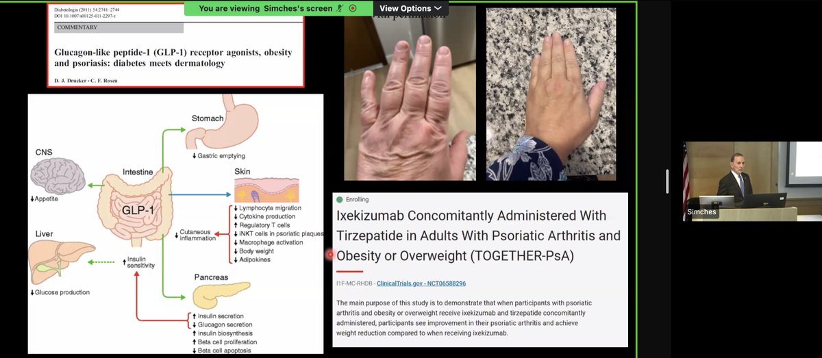 Very cool to see <a href="/DanielJDrucker/">Daniel J Drucker</a> speak about a patient w/profound improvements in their PsA with a single injection of TZP. 

Similar to an experience w/a patient I shared previously. 

Congrats on the Warren Triennial Prize Dr Drucker