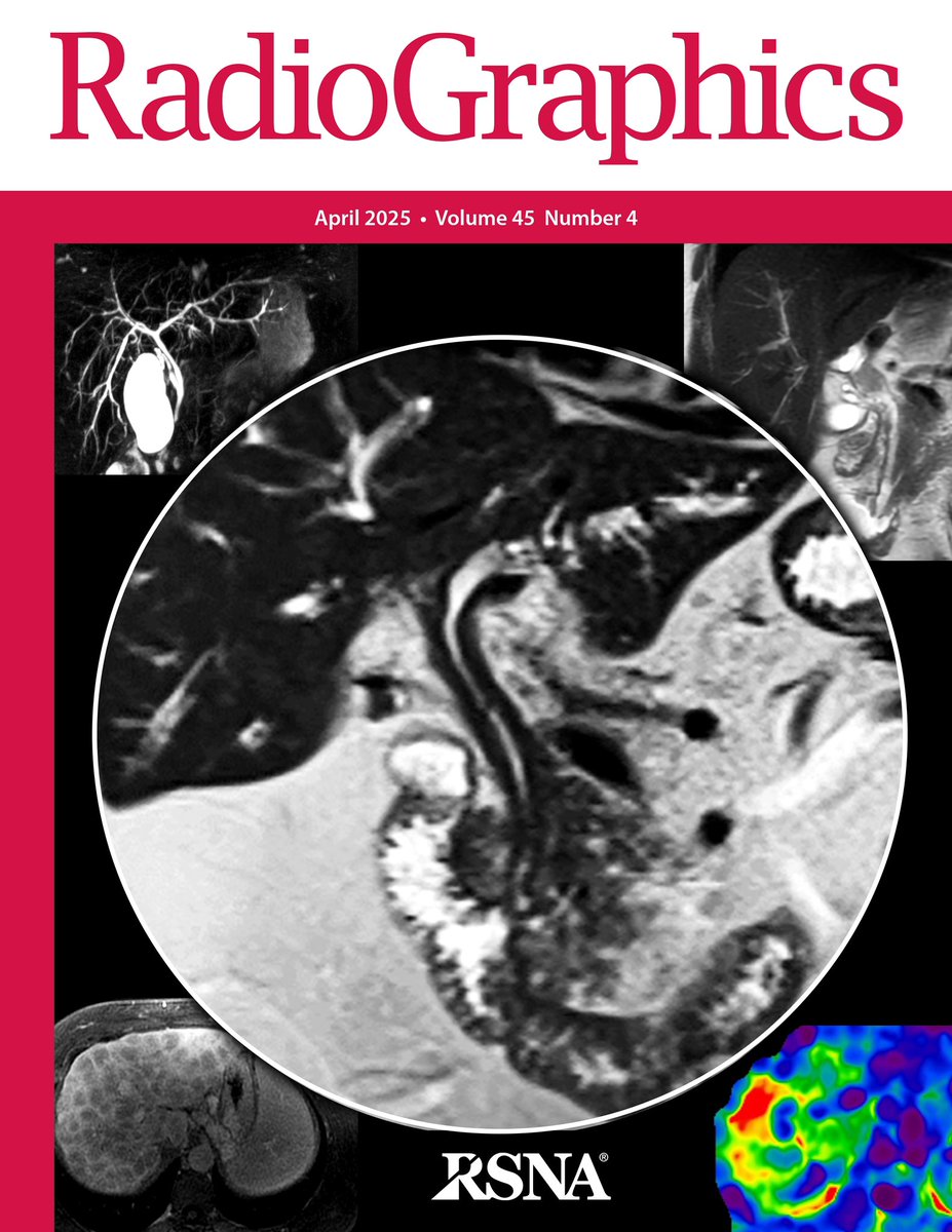 Sudhakar Venkatesh MD (ಸುಧಾಕರ್ ವೆಂಕಟೆೇಶ್) (@mrelastography) on Twitter photo Autoimmune Disorders of the Liver and Biliary Tract | Radiographics pubs.rsna.org/doi/10.1148/rg… <a href="/MayoRadiology/">Mayo Clinic Radiology</a> <a href="/cookyscan1/">Cooky Menias</a> <a href="/AASLDtweets/">AASLD</a> <a href="/ItaniMalak/">Malak Itani</a> <a href="/RachitaKhot/">Rachita Khot</a> <a href="/ChrisWelleMD/">Chris Welle</a> Autoimmune Disorders of the Liver and Biliary Tract | Radiographics pubs.rsna.org/doi/10.1148/rg… <a href="/MayoRadiology/">Mayo Clinic Radiology</a> <a href="/cookyscan1/">Cooky Menias</a> <a href="/AASLDtweets/">AASLD</a> <a href="/ItaniMalak/">Malak Itani</a> <a href="/RachitaKhot/">Rachita Khot</a> <a href="/ChrisWelleMD/">Chris Welle</a>