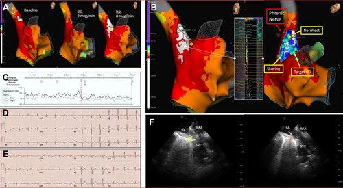 Dr. José Ángel Cabrera (@jacabreracardio) on Twitter photo 👨🎓👩🎓The sinoatrial node
Myoarchitecture of the Sinoatrial Node and its Relevance for Catheter Ablation: Anatomy and Histology
jacc.org/doi/abs/10.101…
👉In the latest issue JACCCR
Part II: Clinical Applications
jacc.org/doi/10.1016/j.…
<a href="/DrAJRestrepo/">Alejandro Jimenez Restrepo</a> <a href="/DamianSanc1955/">Damian Sanchez Quintana</a> <a href="/MRazminia/">Mansour Razminia</a> 👨🎓👩🎓The sinoatrial node
Myoarchitecture of the Sinoatrial Node and its Relevance for Catheter Ablation: Anatomy and Histology
jacc.org/doi/abs/10.101…
👉In the latest issue JACCCR
Part II: Clinical Applications
jacc.org/doi/10.1016/j.…
<a href="/DrAJRestrepo/">Alejandro Jimenez Restrepo</a> <a href="/DamianSanc1955/">Damian Sanchez Quintana</a> <a href="/MRazminia/">Mansour Razminia</a>