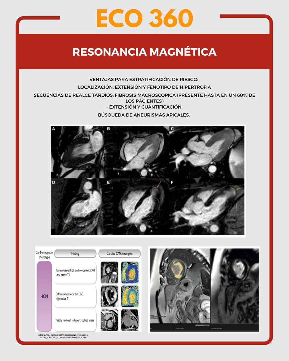 📢 Eco 360 📢

El Abordaje Multimodal de la Miocardiopatía Hipertrófica 🫀🔬 
Descarga nuestra infografía exclusiva y accede a información esencial para mejorar tu práctica clínica.

📩 Descárgala aquí 👉 sonecom.net/eco360

#Eco360 #Cardiología