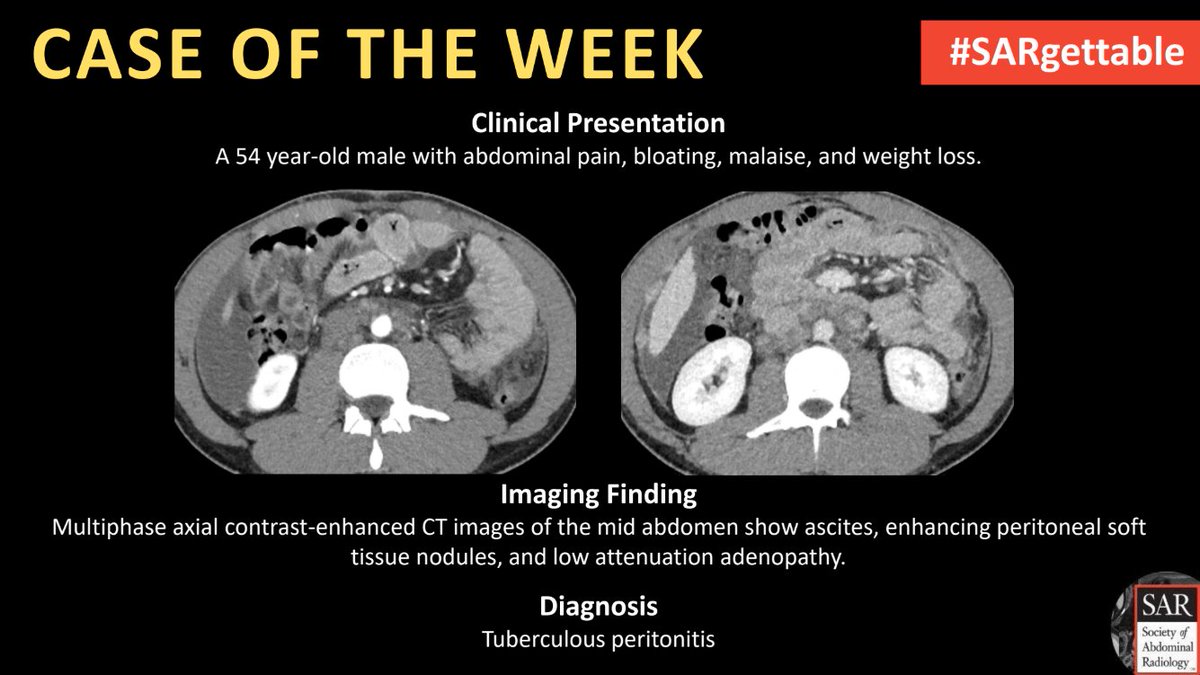 Society of Abdominal Radiology | SAR (@societyabdrad) on Twitter photo The answer to last week's #SARgettable Case of the Week, contributed by <a href="/ErinCookeMD/">Erin Cooke, MD</a>, is: Tuberculous peritonitis. Thanks for playing! The answer to last week's #SARgettable Case of the Week, contributed by <a href="/ErinCookeMD/">Erin Cooke, MD</a>, is: Tuberculous peritonitis. Thanks for playing!