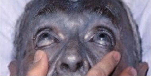 Academic Life in EM (@aliemteam) on Twitter photo ACMT Toxicology Visual Pearl: Turning Blue
What commercially available product can cause blue-grey discoloration of the skin and conjunctiva with long term use?
Benzocaine
Colloidal silver
Ferrous sulfate
Methylene blue
Read more: aliem.com/acmt-turning-b…
<a href="/acmtmedtox/">American College of Medical Toxicology</a> ACMT Toxicology Visual Pearl: Turning Blue
What commercially available product can cause blue-grey discoloration of the skin and conjunctiva with long term use?
Benzocaine
Colloidal silver
Ferrous sulfate
Methylene blue
Read more: aliem.com/acmt-turning-b…
<a href="/acmtmedtox/">American College of Medical Toxicology</a>