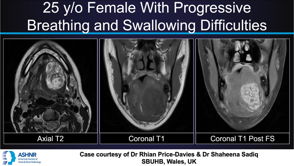ASHNR (@ashnrsociety) on Twitter photo #ASHNRCOTW #291: Dysphagia. Thx <a href="/Rhianpd91/">Rhian Price-Davies</a> + @Shaheena_sadiq 4 case! #ASHNR25
Answer w/ appropriate GIF only -- stay professional & don't spoil it!
<a href="/callyrobs/">Caroline Robson, MBChB</a> <a href="/DShatzkes/">Deborah Shatzkes</a> <a href="/CDP_Rad/">C Douglas Phillips 🇺🇸</a>
<a href="/rhwiggins/">Richard Wiggins</a> <a href="/nakoontz/">Nicholas Koontz</a> <a href="/KRileyMD/">Kalen Riley</a>
<a href="/CMGlastonbury/">Christine M Glastonbury, MD</a> <a href="/tabby_kennedy/">Tabby A. Kennedy, MD</a> <a href="/PhilipRChapman1/">Philip R. Chapman, MD</a>
<a href="/cmtomblinson/">Courtney Tomblinson, MD</a> #ASHNRCOTW #291: Dysphagia. Thx <a href="/Rhianpd91/">Rhian Price-Davies</a> + @Shaheena_sadiq 4 case! #ASHNR25
Answer w/ appropriate GIF only -- stay professional & don't spoil it!
<a href="/callyrobs/">Caroline Robson, MBChB</a> <a href="/DShatzkes/">Deborah Shatzkes</a> <a href="/CDP_Rad/">C Douglas Phillips 🇺🇸</a>
<a href="/rhwiggins/">Richard Wiggins</a> <a href="/nakoontz/">Nicholas Koontz</a> <a href="/KRileyMD/">Kalen Riley</a>
<a href="/CMGlastonbury/">Christine M Glastonbury, MD</a> <a href="/tabby_kennedy/">Tabby A. Kennedy, MD</a> <a href="/PhilipRChapman1/">Philip R. Chapman, MD</a>
<a href="/cmtomblinson/">Courtney Tomblinson, MD</a>