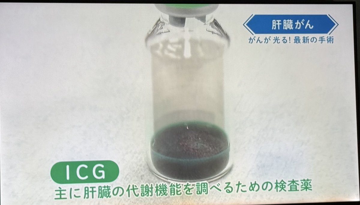 lkhagva7111's tweet image. Японд сүүлийн үел элэгний хавдрын мэс заслын үед ICG хэмээх тодосгогч бодис хэрэглэдэг болж.Энэ бодисыг элгэнд тариад хэсэг хугацааны дараа хавдартай хэсэгт бодис үлддэг аж.Ингэснээр хавдрын голомт тархалтыг үлдээлгүй хагалж үсэрхийлэхгүй сайн болж.Ийм хагалгаа 13,5 сая байдаг.