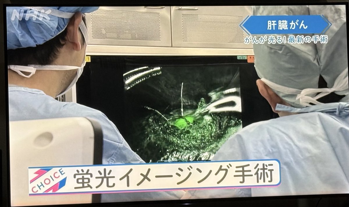 lkhagva7111's tweet image. Японд сүүлийн үел элэгний хавдрын мэс заслын үед ICG хэмээх тодосгогч бодис хэрэглэдэг болж.Энэ бодисыг элгэнд тариад хэсэг хугацааны дараа хавдартай хэсэгт бодис үлддэг аж.Ингэснээр хавдрын голомт тархалтыг үлдээлгүй хагалж үсэрхийлэхгүй сайн болж.Ийм хагалгаа 13,5 сая байдаг.