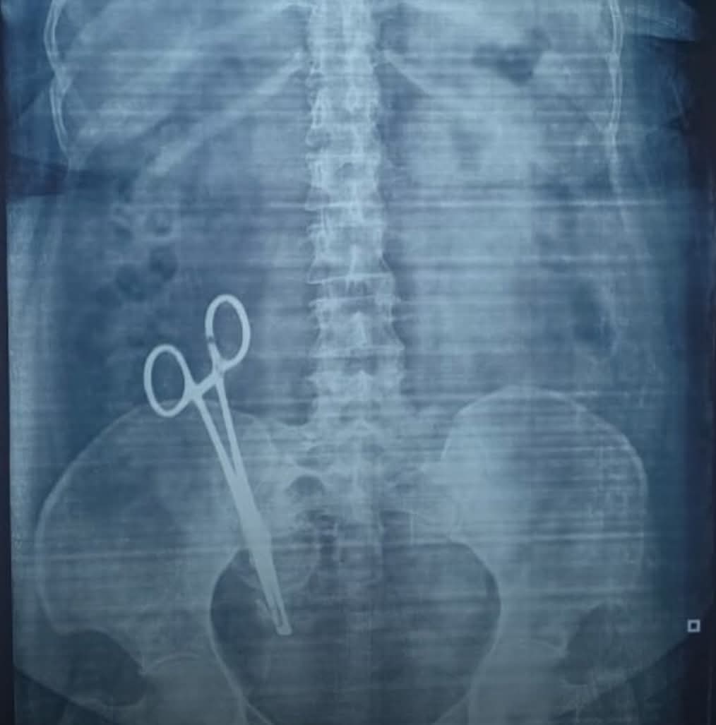 Female patient had abdominal pain for the past 17 years. Pain started after she had a C-section procedure. Abdomen x-ray showed this. What is your diagnosis?