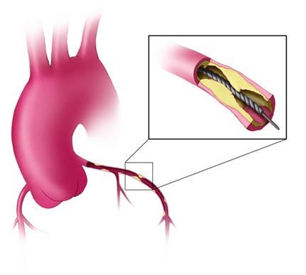 Is Angioplasty Better Than Thrombolysis in MI? 

For STEMI patients, strong evidence favors primary PCI (PTCA) over thrombolysis, reducing mortality, recurrent MI, and stroke.

🔹 PAMI Trial: PTCA lowered in-hospital &amp; 6-month death + recurrent MI.
🔹 GUSTO IIb: Lower rates of