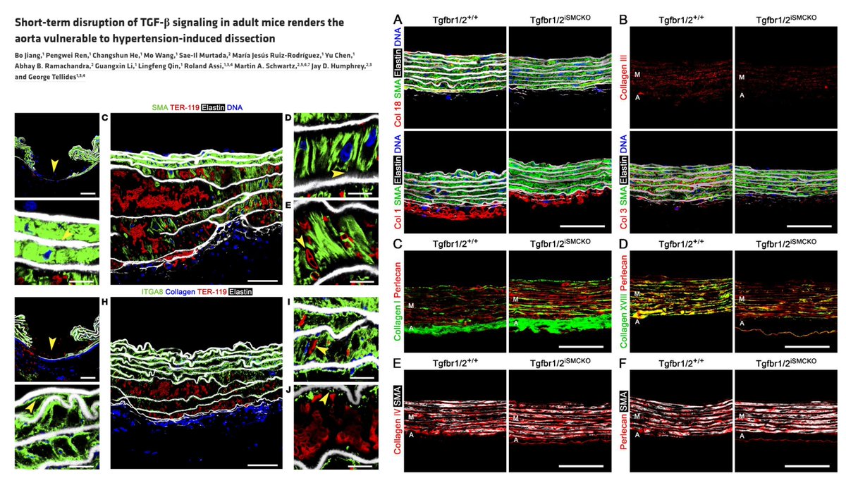HaoYin20's tweet image. #ExtraCellularMatrix & #SmoothMuscleCell-ECM adhesion defects, but Not contractile dysfunction, account for pressure-induced #ThoracicAorticDissection in🐭with short-term TGFβ signaling suppression
11-wk Myh11-CreERT2::Tgfbr1/2 f/f🐭 + 1-wk tamoxifen + norepinephrine
Beautiful…