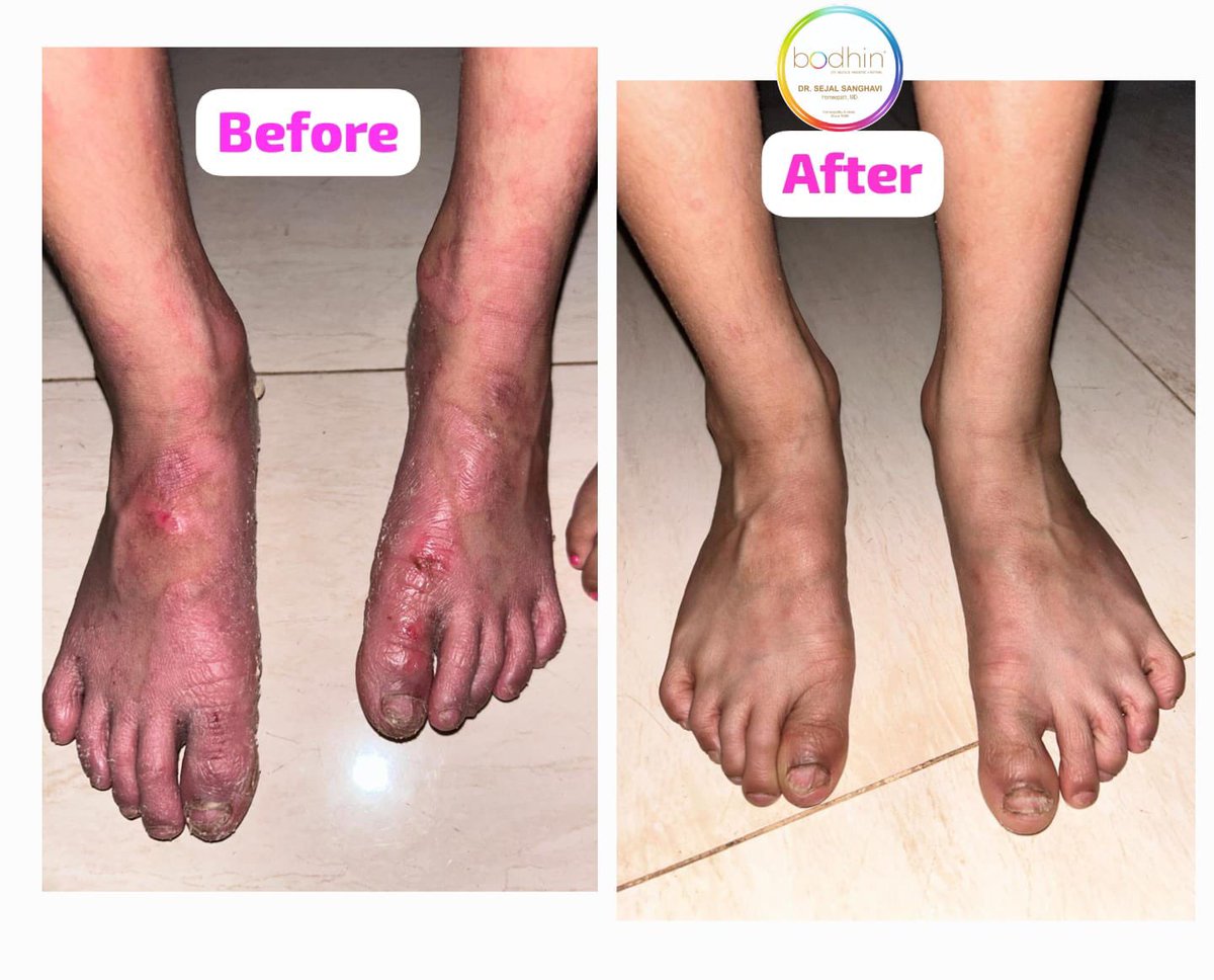 SejalDr's tweet photo. Psoriasis.before and after the treatment. https://t.co/bVdfnYfn4M