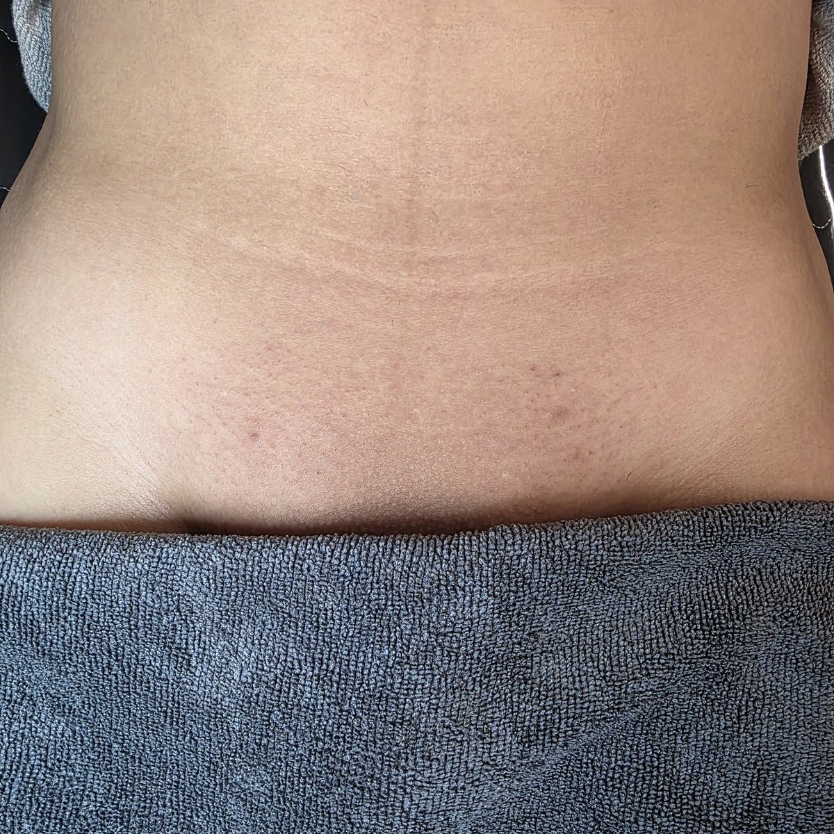 여행 전 방문하신 고객님☺️ 
깔끔하게 뽑아드렸습니다-!

✓ 남자 원장님의 1:1 맞춤 예약 관리
✓ 시술 후 모든 기구, 용품 소독 및 1회 용품 사용
✓ 샤워실 완비
​✓ 당일 예약 가능

 문의 : open.kakao.com/o/sXF03Mzf

#인천남자왁싱 #남자왁서 #인하대 #부평 #주안 #송도 #제물포