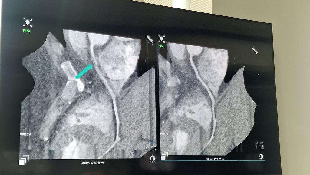 BSCImaging's tweet image. Selecting the right protocol for the right patient, post processing and maintaining efficient multidisciplinary communication ensures we maintain high diagnostic standards. #WhyCCT #BSCI2025