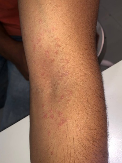 A 30-year-old man (Fitzpatrick skin type IV) presented with asymptomatic, multiple well-defined, round to oval erythematous nonblanchable macules, with scaling on the left cubital fossa, for a duration of 1 month. What's your diagnosis? doi.org/10.1093/skinhd… #SHD