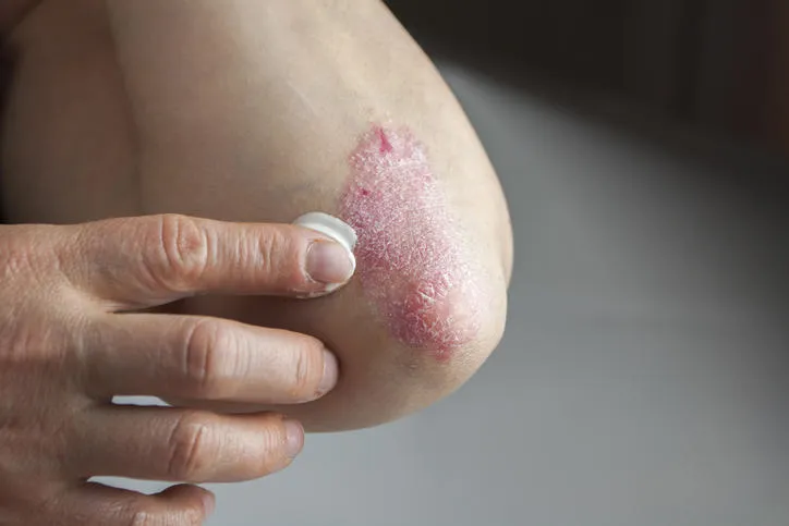 UoB School of Medical Sciences (@uobmedicalsci) on Twitter photo Exciting new research from <a href="/unibirmingham/">Uni of Birmingham</a> has shown that a sequence of just three amino acids from the PEPITEM molecule may reduce the severity of #psoriasis, when applied topically in an emollient cream. <a href="/CVS_UoB/">Cardiovascular Sciences (CVS)- UoB</a> <a href="/BirminghamBRC/">NIHR Birmingham Biomedical Research Centre</a> <a href="/unibirm_CMH/">College of Medicine and Health (UoB)</a>
birmingham.ac.uk/news/2025/pepi… Exciting new research from <a href="/unibirmingham/">Uni of Birmingham</a> has shown that a sequence of just three amino acids from the PEPITEM molecule may reduce the severity of #psoriasis, when applied topically in an emollient cream. <a href="/CVS_UoB/">Cardiovascular Sciences (CVS)- UoB</a> <a href="/BirminghamBRC/">NIHR Birmingham Biomedical Research Centre</a> <a href="/unibirm_CMH/">College of Medicine and Health (UoB)</a>
birmingham.ac.uk/news/2025/pepi…