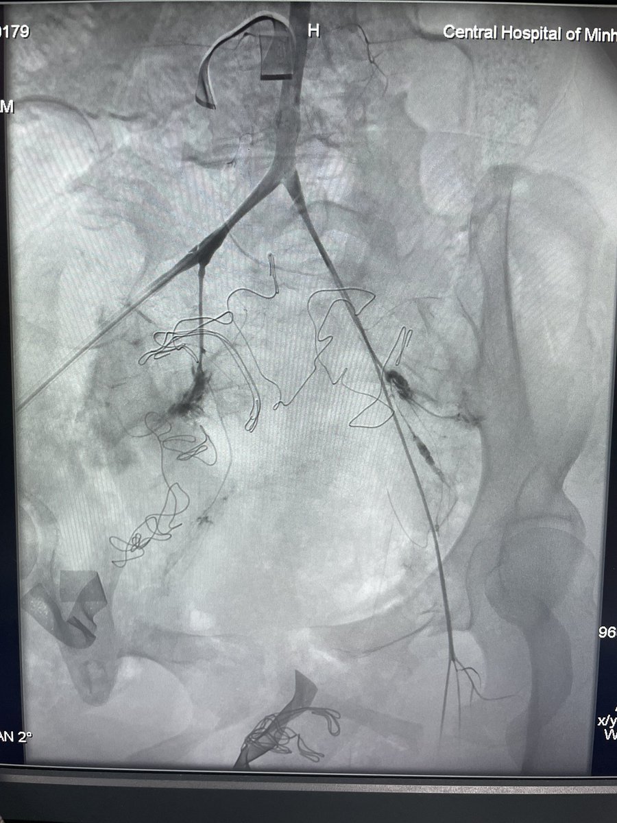 A shock patient after receiving a high dose of adrenaline