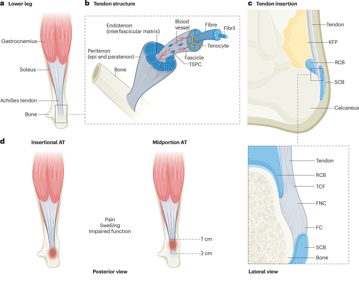 ⚽🤕 Achilles Tendinopathy 

nature.com/articles/s4157…