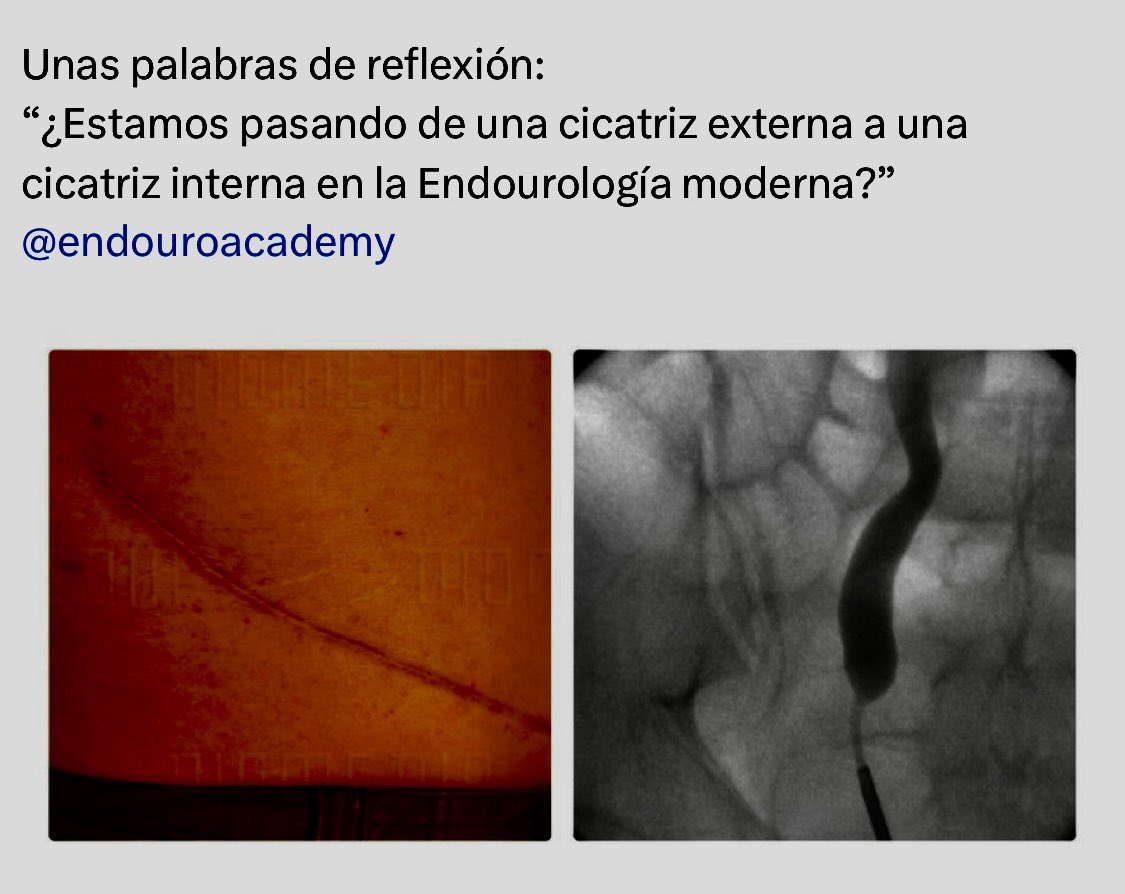 Alfredo Sanchez Urólogo (@lfredosanchez) on Twitter photo <a href="/Mohamedendourol/">Mohamed_omar</a> <a href="/endouroacademy/">Endourology Academy</a> <a href="/TFL_URO_APIS/">APIS KidneyStone Institute, TFL EndoUrology Center</a> <a href="/Endo_Society/">Endourological Society</a> <a href="/EndoLuminalEndo/">Daron Smith</a> <a href="/endourologyucsd/">Manoj Monga</a> <a href="/young_endosoc/">Young Endo Society</a> <a href="/StefaniaFerret/">Stefania Ferretti</a> <a href="/drkemalsarica/">Kemal Sarıca</a> <a href="/Urologeman/">Urologeman (Nariman Gadzhiev)</a> <a href="/OTRAXER/">Olivier Traxer</a> Are we moving from an external scar to an internal scar in modern Endourology? <a href="/Mohamedendourol/">Mohamed_omar</a> <a href="/endouroacademy/">Endourology Academy</a> <a href="/TFL_URO_APIS/">APIS KidneyStone Institute, TFL EndoUrology Center</a> <a href="/Endo_Society/">Endourological Society</a> <a href="/EndoLuminalEndo/">Daron Smith</a> <a href="/endourologyucsd/">Manoj Monga</a> <a href="/young_endosoc/">Young Endo Society</a> <a href="/StefaniaFerret/">Stefania Ferretti</a> <a href="/drkemalsarica/">Kemal Sarıca</a> <a href="/Urologeman/">Urologeman (Nariman Gadzhiev)</a> <a href="/OTRAXER/">Olivier Traxer</a> Are we moving from an external scar to an internal scar in modern Endourology?