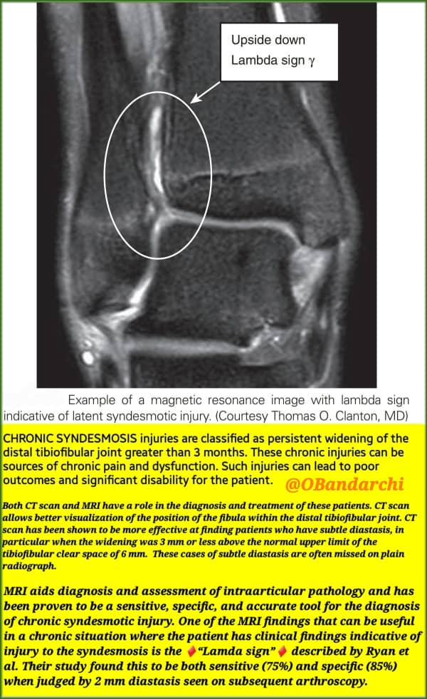 🛑Chronic syndesmotic injuries =persistent widening of tibiofibular joint 3mos after initial injury.

Both CT &amp; MRI have a role in diagnosis &amp; treatment.

“Lamda sign” on MRI has a sensitivity of 75% &amp; specficity of 85% when judged by 2 mm diastasis seen on subsequent arthroscopy