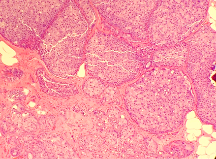 MhPathology's tweet image. 75F with abnormal screening mammogram → biopsy.
🔬p63+, E-cadherin loss
📌Dx: Pleomorphic LCIS with apocrine features, necrosis &amp;amp; microcalcifications.

⚡Key takeaway: Pleomorphic LCIS can mimic high-grade DCIS—E-cadherin loss is the clue!
#Pathology #Pathtwitter #BreastPath