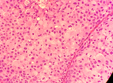 MhPathology's tweet image. 75F with abnormal screening mammogram → biopsy.
🔬p63+, E-cadherin loss
📌Dx: Pleomorphic LCIS with apocrine features, necrosis &amp;amp; microcalcifications.

⚡Key takeaway: Pleomorphic LCIS can mimic high-grade DCIS—E-cadherin loss is the clue!
#Pathology #Pathtwitter #BreastPath