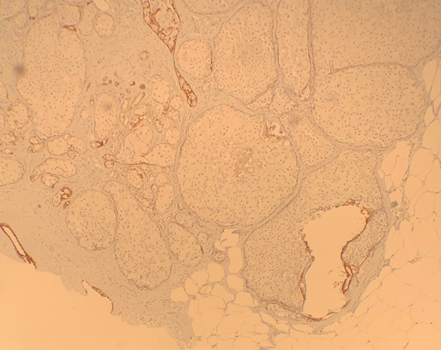 MhPathology's tweet image. 75F with abnormal screening mammogram → biopsy.
🔬p63+, E-cadherin loss
📌Dx: Pleomorphic LCIS with apocrine features, necrosis &amp;amp; microcalcifications.

⚡Key takeaway: Pleomorphic LCIS can mimic high-grade DCIS—E-cadherin loss is the clue!
#Pathology #Pathtwitter #BreastPath