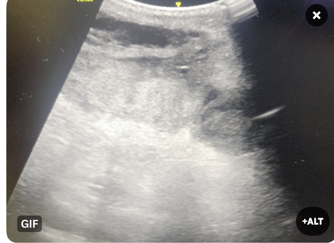 Nasrawi7's tweet photo. Post abdominoplasty with shock fast negative but be careful of hematoma above the rectus  sheath .. patient went for or for evacuation .. notice fresh blood anechoic mixed with hypo-echoic and iso echoic  
#empocus https://t.co/kq8N5zoyAW