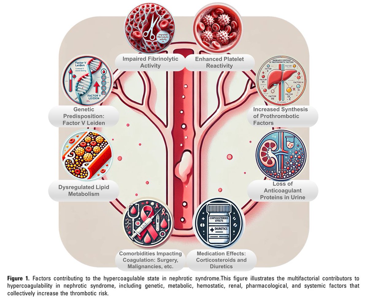 edgarvlermamd's tweet photo. Venous Thromboembolism Prevention in Nephrotic Syndrome: The Role of Aspirin, Vitamin K Antagonists, and Direct Oral Anticoagulants ca. 2025 from @KIReports @SaynaNorouzi @GlassockJ @kdjhaveri @AlJurdi @rahaai @ZohrehGh7 
#Nephpearls

👉 https://t.co/XNPY7JtPf7 https://t.co/Px1vwdjHIq