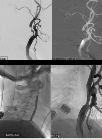 Rizwan Tahir (@riztahirmd) on Twitter photo Same day, same disease, 2 very different patients, 2 different but equal procedures. Carotid Endarterectomy vs. Angioplasty stent. Do what’s best for the patient! <a href="/MedStarWHC/">MedStar Washington</a> <a href="/MGUHNeurosurg/">Georgetown/WHC Neurosurgery</a> #carotidstenosis #CREST #dualtrained #cerebrovascular #endovascular Same day, same disease, 2 very different patients, 2 different but equal procedures. Carotid Endarterectomy vs. Angioplasty stent. Do what’s best for the patient! <a href="/MedStarWHC/">MedStar Washington</a> <a href="/MGUHNeurosurg/">Georgetown/WHC Neurosurgery</a> #carotidstenosis #CREST #dualtrained #cerebrovascular #endovascular