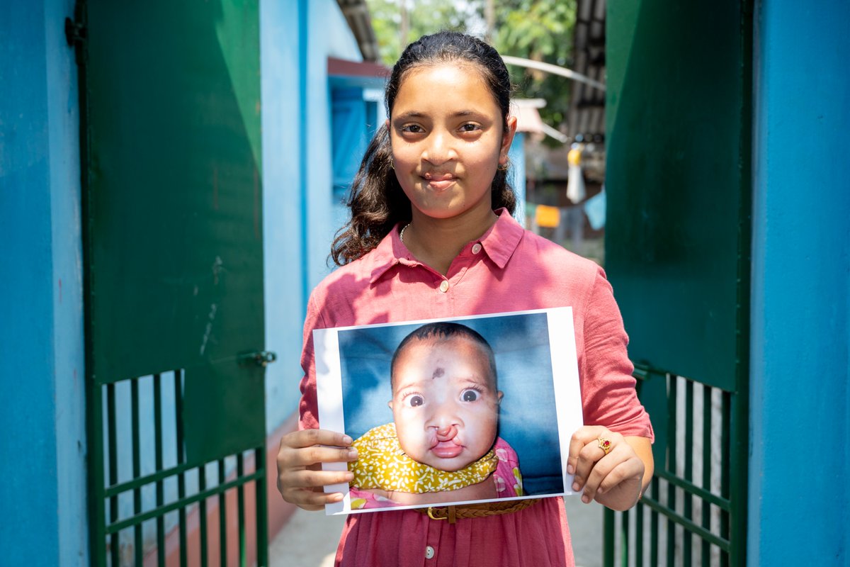 SmileTrainIndia's tweet photo. Every smile is priceless. Meet Bhawna, a bright young girl from Darjeeling whose life was forever changed by a cleft surgery, made possible by Smile Train's partner Anandloke Multispeciality Hospital. Born with a cleft, she faced feeding challenges & uncertainty, but thanks to compassionate care, she's now thriving! 
However, thousands of children like Bhawna still need help. You can be the reason they smile freely & confidently. Donate now & bring hope to a child's future! 💙 
#SmileTrainIndia #HopeForEveryChild #ChangingLives #CleftWarrior