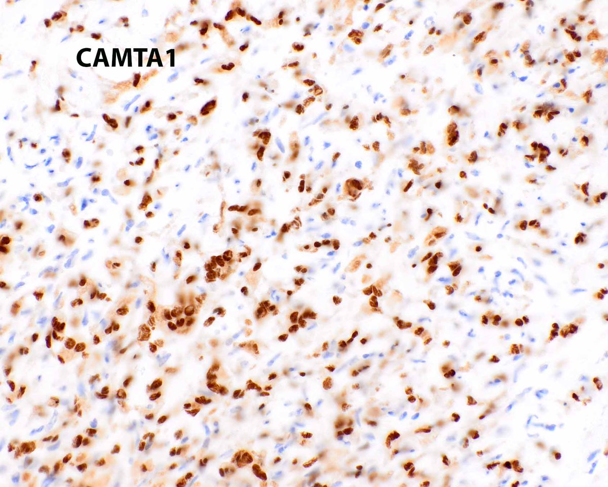 This insane epithelioid hemangioendothelioma arose in the neck and has a lymphoid cuff - both of which mimic epithelioid hemangioma.  CAMTA is confirmatory.  Note the intracytoplasmic lumen with an erythrocyte (arrow).