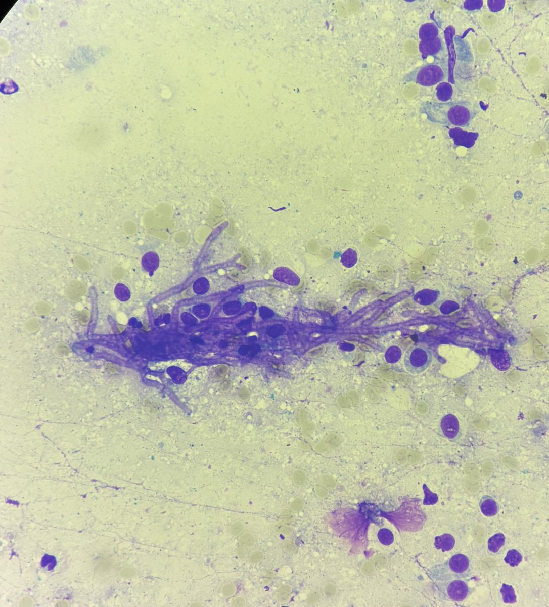 Israh Akhtar Khan (@israhkhan) on Twitter photo Here we go -Fungal hyphae c/w Aspergillous
Cytology to the rescue -reported in less than 10 minutes -
No previous diagnosis
As my friend <a href="/smlungpathguy/">Sanjay Mukhopadhyay</a> says #crittersontwitter Here we go -Fungal hyphae c/w Aspergillous
Cytology to the rescue -reported in less than 10 minutes -
No previous diagnosis
As my friend <a href="/smlungpathguy/">Sanjay Mukhopadhyay</a> says #crittersontwitter