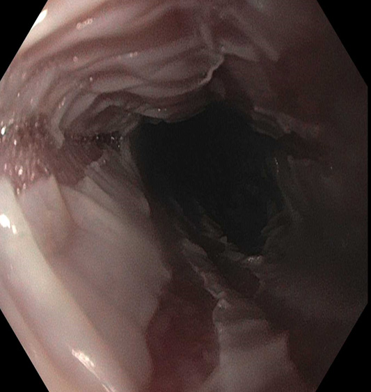 What is this?  Why, it's esophagitis dissecans (sloughing esophagitis).  Learn a few gastrointestinal pearls with us 26-27 April from the privacy of your own place!

med.miami.edu/departments/pa…