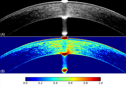 TVST Journal (@arvotvst) on Twitter photo In the New Frontiers in Optical Coherence Tomography Issue bit.ly/3u6vw7v, Jad Assaf et al. <a href="/assafjad/">Jad F. Assaf</a> <a href="/CaseyEye/">OHSU Casey Eye</a> present a Characterization of Directional Reflectance in Corneal Tissue: A Comprehensive Optical Coherence Tomography Analysis, tvst.arvojournals.org/article.aspx?a…. In the New Frontiers in Optical Coherence Tomography Issue bit.ly/3u6vw7v, Jad Assaf et al. <a href="/assafjad/">Jad F. Assaf</a> <a href="/CaseyEye/">OHSU Casey Eye</a> present a Characterization of Directional Reflectance in Corneal Tissue: A Comprehensive Optical Coherence Tomography Analysis, tvst.arvojournals.org/article.aspx?a….