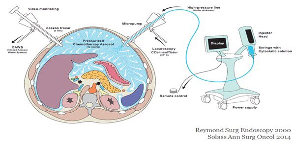Alvaro Arjona (@alarjosan) on Twitter photo PIPAC is an effective treatment to control the peritoneal malignant diseases in gastric, colon, ovarian and meshotelioma. We have introduced this technique for selected patients <a href="/HUReinaSofia/">Hospital Universitario Reina Sofía</a> <a href="/HcrCordoba/">Hospital Cruz Roja de Córdoba</a> <a href="/ISSPP1/">ISSPP</a> <a href="/ChiaClaramae/">Claramae Chia</a> <a href="/operarelcancer/">SEOQ | Los cirujanos del cáncer #operarelcancer</a> <a href="/GrupoTTD/">Grupo Español de Tratamiento de Tumores Digestivos</a> PIPAC is an effective treatment to control the peritoneal malignant diseases in gastric, colon, ovarian and meshotelioma. We have introduced this technique for selected patients <a href="/HUReinaSofia/">Hospital Universitario Reina Sofía</a> <a href="/HcrCordoba/">Hospital Cruz Roja de Córdoba</a> <a href="/ISSPP1/">ISSPP</a> <a href="/ChiaClaramae/">Claramae Chia</a> <a href="/operarelcancer/">SEOQ | Los cirujanos del cáncer #operarelcancer</a> <a href="/GrupoTTD/">Grupo Español de Tratamiento de Tumores Digestivos</a>