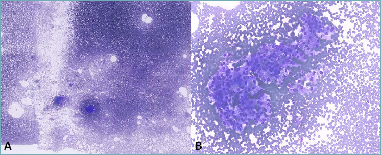 Published in #Pathologica:
«Interventional cytopathologist perspective on the Milan System Classification: a study on 929 consecutive salivary gland fine-needle aspirations with a focus on challenging diagnostic categories»
#PathX #CytoPath 
Read at pathologica.it/article/view/8…