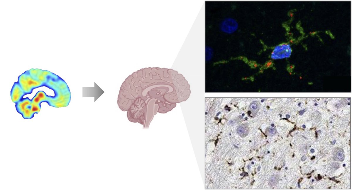 TSPO PET is used to measure inflammation in dementia, but its cellular basis is unclear. Using PET imaging and post-mortem brain tissue, Wijesinghe et al. show that microglia are the key immune cells driving TSPO PET signal changes. tinyurl.com/mwpxdcc6