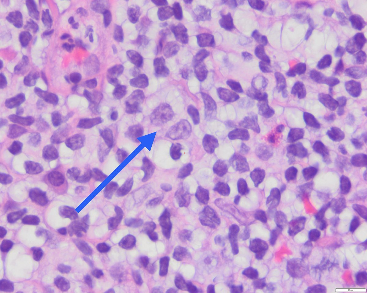 Sanam Loghavi, MD صنم لغوی 🔬🧬 (@sanamloghavi) on Twitter photo Follicular dendritic cells: the most romantic cells of all 💘
It’s not for nothing that we call them the “kissing cells” 🧑❤️💋🧑 Follicular dendritic cells: the most romantic cells of all 💘
It’s not for nothing that we call them the “kissing cells” 🧑❤️💋🧑