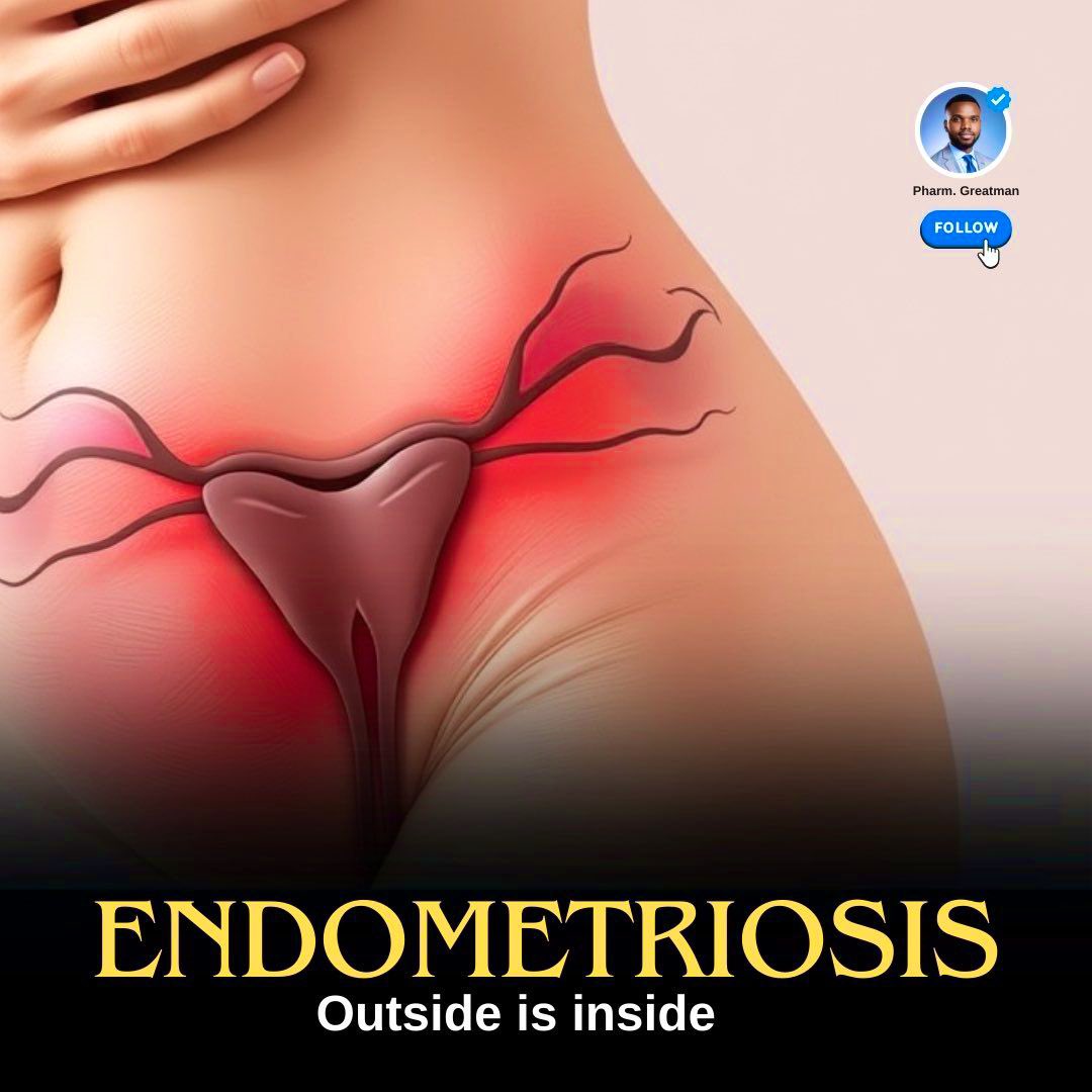 OGreat6's tweet photo. ENDOMETRIOSIS AWARENESS

Endometriosis affects millions of women, yet it’s often misunderstood or misdiagnosed.  

Severe pain, fertility struggles, and daily discomfort, this condition is more than just "bad periods."  

This is what you need to know about endometriosis.

Bookmark for later