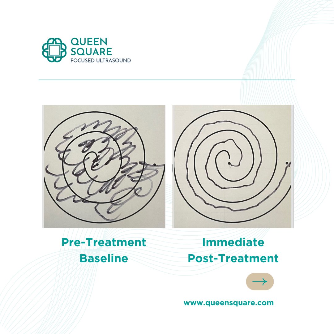 QueenSquareFUS's tweet image. Regaining control isn’t just physical—it’s emotional.
Many of our patients who undergo Focused Ultrasound say they feel like their life is beginning again after treatment.
🔗 - queensquare.com/focused-ultras…
#EssentialTremor #ParkinsonsDisease #LivingWithTremor #FocusedUltrasound