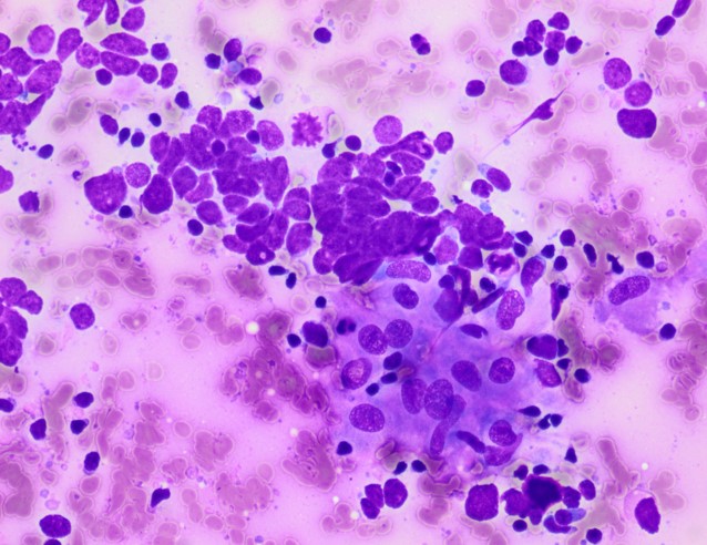 Pepe Jiménez Heffernan (@pepeheffernan) on Twitter photo CC358. In her 60s. Supraclavicular lymph node. What is happening here? Relevant or bah? case of a colleague <a href="/kriyer68/">Kalyani Bambal</a> <a href="/DrMarkOng/">Mark Ong</a> <a href="/DrCycloPath/">Charlie Herndon</a> <a href="/DrBMcGinn/">Barry McGinn</a> CC358. In her 60s. Supraclavicular lymph node. What is happening here? Relevant or bah? case of a colleague <a href="/kriyer68/">Kalyani Bambal</a> <a href="/DrMarkOng/">Mark Ong</a> <a href="/DrCycloPath/">Charlie Herndon</a> <a href="/DrBMcGinn/">Barry McGinn</a>