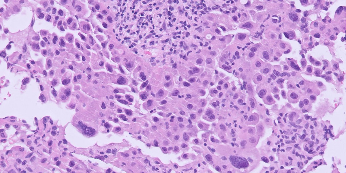 1/ Your favorite #breastpath topic....papillary lesions...core needle biopsy from a BI-RADS 5 lesion...
What is your diagnosis #pathtwitter?