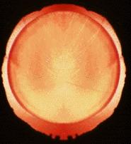 EGGOTW#12 👀🧬

Today we’ll discuss the ‘pan-ocular condition’ aniridia.

This condition may affect multiple areas of the eye from the cornea to the optic nerve.

1/10