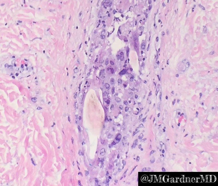 What’s wrong with this hair follicle??? 
Answer ✅ youtu.be/pDDKogUoJ5Y
#pathology #pathologists #pathTwitter #dermpath #dermatology #dermatologia #dermtwitter #usmle