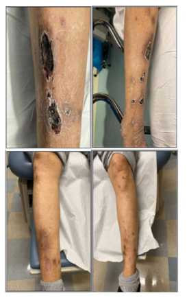 Vaishali Sanchorawala (@vsanchorawala) on Twitter photo Effective and safe treatment for this disease! #bispecificrocks <a href="/BU_Amyloidosis/">BU Amyloidosis Center</a>
Teclistamab therapy for refractory type 1 cryoglobulinemia pubmed.ncbi.nlm.nih.gov/40109179/ Effective and safe treatment for this disease! #bispecificrocks <a href="/BU_Amyloidosis/">BU Amyloidosis Center</a>
Teclistamab therapy for refractory type 1 cryoglobulinemia pubmed.ncbi.nlm.nih.gov/40109179/
