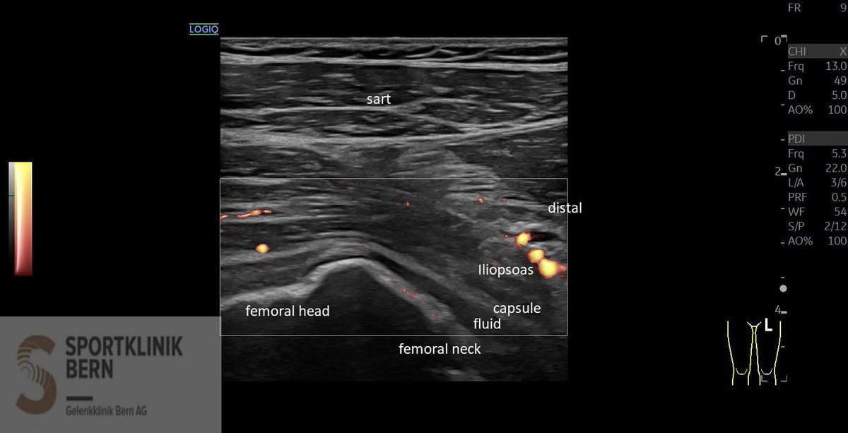 SportklinikBern's tweet photo. Severe #hiparthrosis due to impingement—> #ultrasoundguidedinjection with #arthrexprp and #ostenilplus - #mskus #pocus #pocushub #GElogiqE10sr4 https://t.co/KkkbS9tgfV
