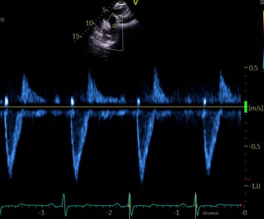 A patient with known bicuspid aortic valve. The descending aorta is sampled using PW Doppler in the suprasternal view. 1/2