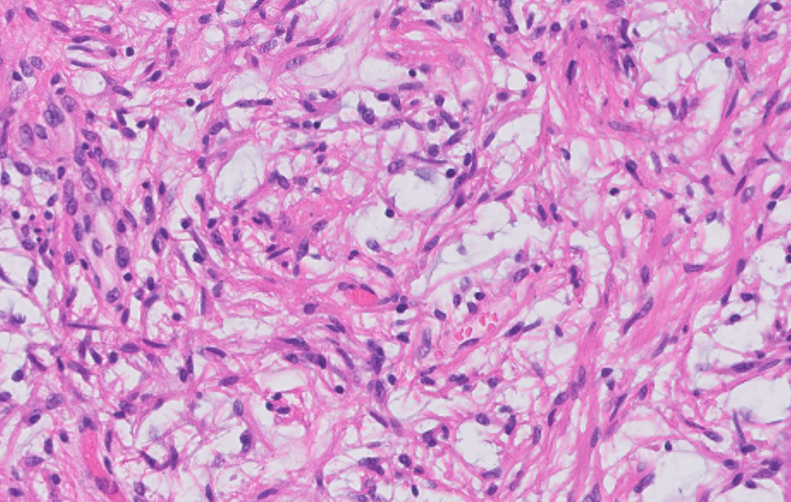 3rd ventricular tumor - 2yo

Good morphological evaluation and clinico-radiological correlation is enough to make the diagnosis of Pilocytic astrocytoma (grade 1)

But indeed, if 2nd generation BRAF-inhibitors are needed and accessible, demonstrating BRAF fusion becomes mandatory