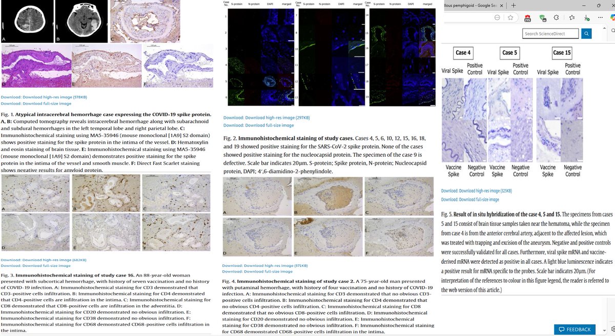 🚨🔥URGENT! Japanese Scientists published new study(3 April 2025), showing new evidence of COV-19 mRNA vaccine spike protein persisting in cerebral arteries of 43.8% of haemorrhagic stroke patients up to 17 months post-vaccination with absence of infection, express concerns about