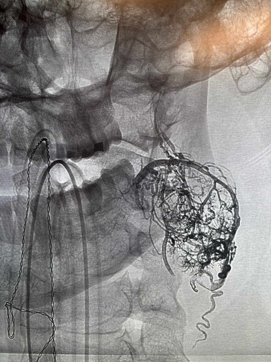 Can you guess what was treated here? #ynis #NeuroIR