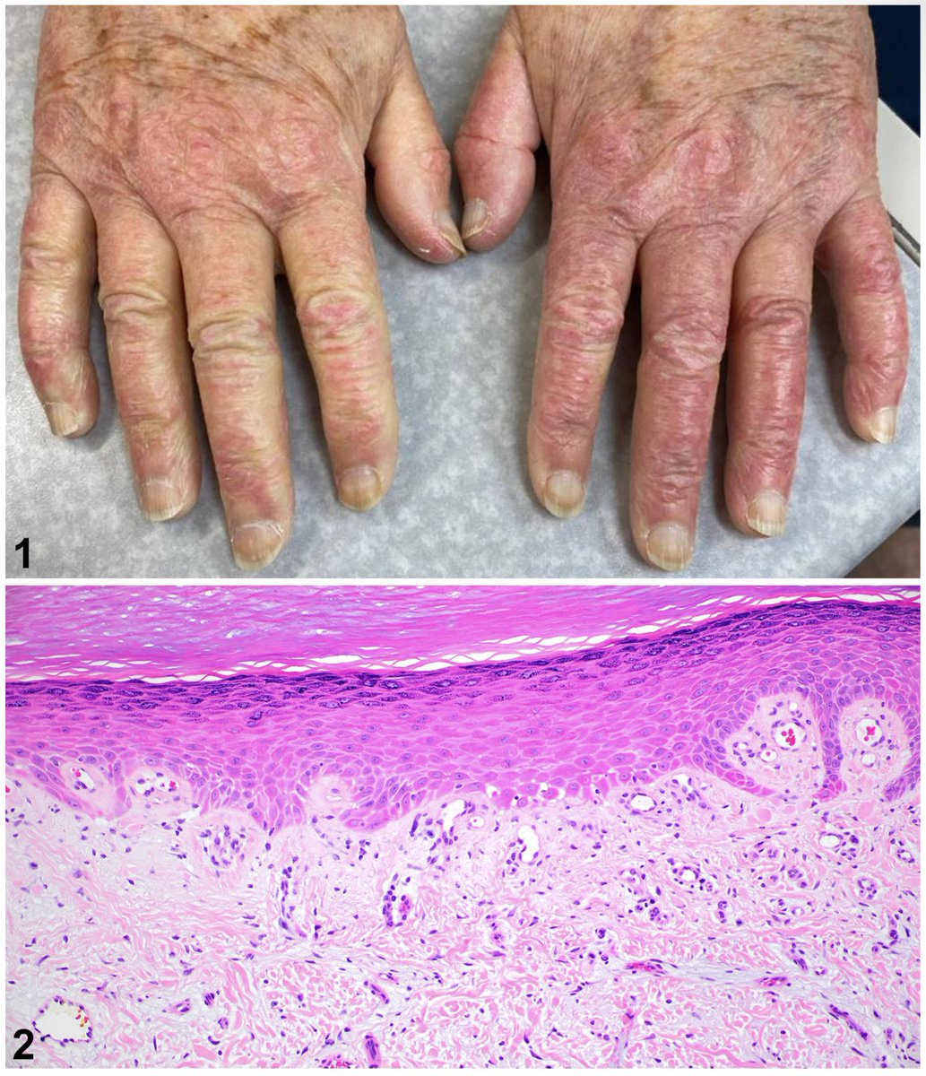 #Hydroxyurea-induced #dermatomyositis (DM)-like eruption is a rare skin reaction characterized by scaly erythematous to violaceous papules and plaques with atrophy and telangiectasias on the dorsal hands, clinically indistinguishable from true DM. However, DM-like eruption cases
